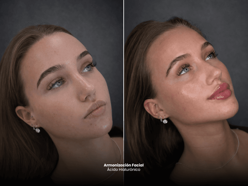 Armonización facial
